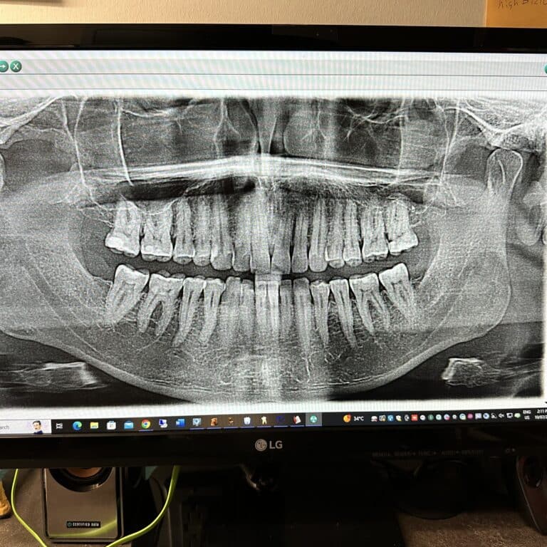 Full Mouth Restoration Calgary